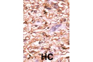 Immunohistochemistry (IHC) image for anti-Tumor Protein P53 (TP53) (pThr18) antibody (ABIN2970970)
