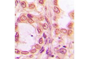 Immunohistochemical analysis of PRPF19 staining in human breast cancer formalin fixed paraffin embedded tissue section.
