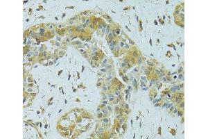 Immunohistochemistry of paraffin-embedded Human breast cancer using MTCH1 Polyclonal Antibody at dilution of 1:100 (40x lens).