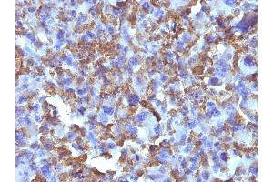 Formalin-fixed, paraffin-embedded human Histiocytoma stained with Macrophage Monoclonal Antibody (D11). (Macrophage / Histiocytoma Marker anticorps)
