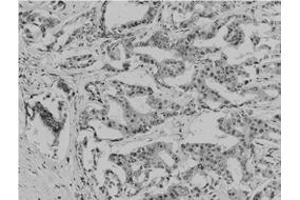 Immunohistochemical staining of paraffin-embedded human breast carcinoma tissue reacted with Acetyl lysine monoclonal antibody  at 1:200-1:500 dilution. (Acetylated Lysine anticorps  (acetylated))