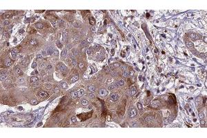 ABIN6276575 at 1/100 staining Human liver cancer tissue by IHC-P.