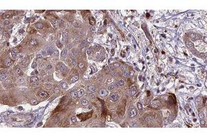 ABIN6276575 at 1/100 staining Human liver cancer tissue by IHC-P. (CAPNL1 anticorps  (N-Term))