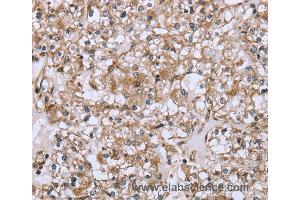 Immunohistochemistry of Human prostate cancer using FCAR Polyclonal Antibody at dilution of 1:20 (FCAR anticorps)