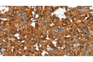 Immunohistochemistry of paraffin-embedded Human thyroid cancer using CTBP1 Polyclonal Antibody at dilution of 1:40 (CTBP1 anticorps)