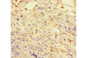 Immunohistochemistry of paraffin-embedded human melanoma using ABIN7150550 at dilution of 1:100