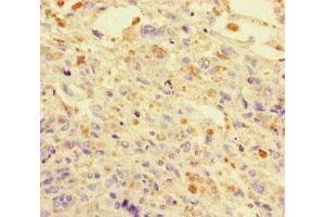 Immunohistochemistry of paraffin-embedded human melanoma using ABIN7150550 at dilution of 1:100 (DNAJC3 anticorps  (AA 277-496))