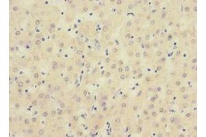 Immunohistochemistry of paraffin-embedded human liver cancer using ABIN7169723 at dilution of 1:100