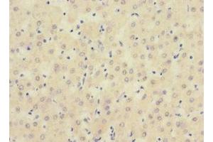 Immunohistochemistry of paraffin-embedded human liver cancer using ABIN7169723 at dilution of 1:100 (SIGIRR anticorps  (AA 1-120))