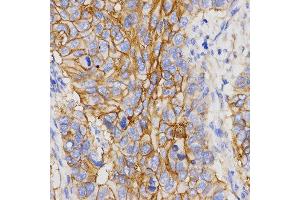 Immunohistochemistry of paraffin-embedded human stomach cancer tissue using PGC antibody at dilution of 1:200 (x400 lens)
