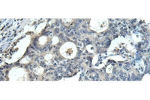 Immunohistochemistry of paraffin-embedded Human colorectal cancer tissue using FCRLA Polyclonal Antibody at dilution of 1:90(x200) (FCRLA anticorps)