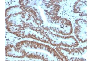 Formalin-fixed, paraffin-embedded human Colon Carcinoma stained with BMI1 Mouse Monoclonal Antibody (BMI1/2823).