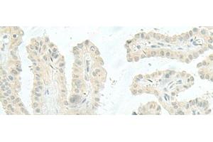 Immunohistochemistry of paraffin-embedded Human thyroid cancer tissue using MIEN1 Polyclonal Antibody at dilution of 1:45(x200) (C17orf37 anticorps)