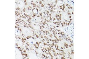 Immunohistochemistry of paraffin-embedded Human colon carcinoma using EP300 antibody (ABIN6127823, ABIN6140193, ABIN6140194 and ABIN6216844) at dilution of 1:100 (40x lens).