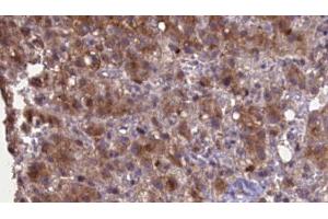 ABIN6276969 at 1/100 staining Human liver cancer tissue by IHC-P. (GRIK2 anticorps  (Internal Region))