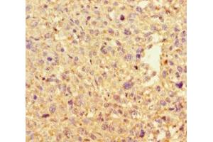 Immunohistochemistry of paraffin-embedded human melanoma using ABIN7150029 at dilution of 1:100