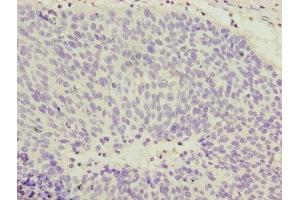 Immunohistochemistry of paraffin-embedded human cervical cancer using ABIN7148022 at dilution of 1:100 (COPZ1 anticorps  (AA 1-177))