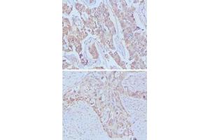 Immunohistochemical analysis of paraffin-embedded human breast cancer (upper) and lung cancer (bottom) tissues using EGF monoclonal antibody, clone 9D7F11  . (EGF anticorps)