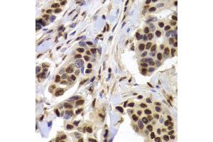 Immunohistochemistry of paraffin-embedded human breast cancer using XRCC5 Antibody.