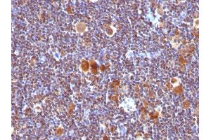 Formalin-fixed, paraffin-embedded human Hodgkin's Lymphoma stained with Bax Monoclonal Antibody (Clone SPM33). (BAX anticorps  (AA 3-16))