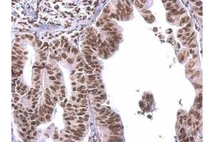 IHC-P Image COBRA1 antibody detects COBRA1 protein at nucleus on human gastric cancer by immunohistochemical analysis. (COBRA1 anticorps  (Center))