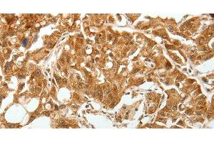 Immunohistochemistry of paraffin-embedded Human lung cancer tissue using TGF β Receptor I Polyclonal Antibody at dilution 1:60