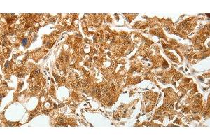 Immunohistochemistry of paraffin-embedded Human lung cancer tissue using TGF β Receptor I Polyclonal Antibody at dilution 1:60 (TGFBR1 anticorps)