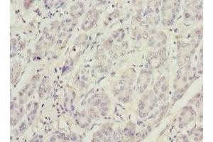 Immunohistochemistry of paraffin-embedded human liver cancer using ABIN7163403 at dilution of 1:100