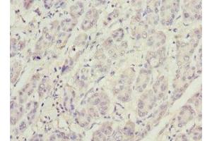 Immunohistochemistry of paraffin-embedded human liver cancer using ABIN7163403 at dilution of 1:100 (PHKG2 anticorps  (AA 237-406))