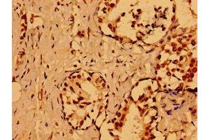 Immunohistochemistry of paraffin-embedded human breast cancer using ABIN7161807 at dilution of 1:100 (NUMA1 anticorps  (AA 627-870))