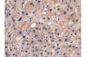 Detection of FGF21 in Human Liver cancer Tissue using Monoclonal Antibody to Fibroblast Growth Factor 21 (FGF21)