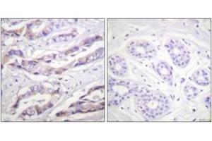 Immunohistochemistry analysis of paraffin-embedded human breast carcinoma, using p70 S6 Kinase (Phospho-Thr389) Antibody. (RPS6KB1 anticorps  (pThr412))