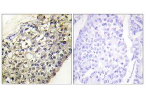 Immunohistochemistry analysis of paraffin-embedded human breast carcinoma tissue, using LATH antibody. (LATH anticorps  (Internal Region))