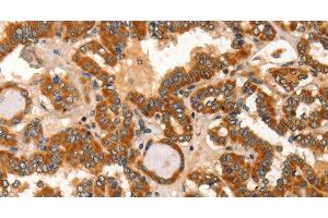 Immunohistochemistry of paraffin-embedded Human thyroid cancer tissue using IKZF3 Polyclonal Antibody at dilution 1:60 (IKZF3 anticorps)