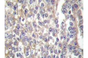 Immunohistochemistry  analyzes of Shc antibody in paraffin-embedded human breast carcinoma tissue. (SHC1 anticorps)