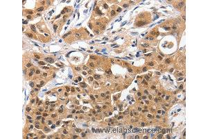 Immunohistochemistry of Human lung cancer using YWHAE Polyclonal Antibody at dilution of 1:100 (YWHAE anticorps)