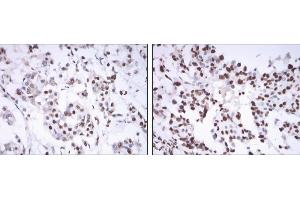 Immunohistochemical analysis of paraffin-embedded mammary cancer tissues using ESR1 mouse mAb with DAB staining. (Estrogen Receptor alpha anticorps)
