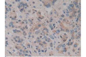 IHC-P analysis of Human Prostate Gland Cancer Tissue, with DAB staining. (HPR anticorps  (AA 70-332))