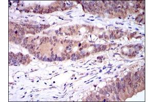 Immunohistochemical analysis of paraffin-embedded colon cancer tissues using CASP8 mouse mAb with DAB staining.