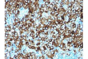 Formalin-fixed, paraffin-embedded human Melanoma stained with gp100 Rabbit Polyclonal Antibody. (Melanoma gp100 anticorps)