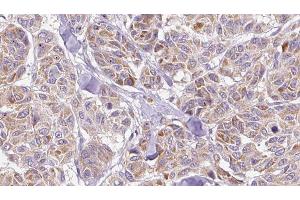 ABIN6278488 at 1/100 staining Human Melanoma tissue by IHC-P. (CCL3 anticorps  (Internal Region))