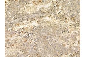 ABIN6258772 and ABIN6274897 at 1/100 staining human melanoma by IHC-P. (EPB41L2 anticorps  (Internal Region))