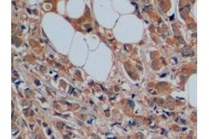Detection of SERT in Human Breast cancer Tissue using Polyclonal Antibody to Serotonin Transporter (SERT) (SLC6A4 anticorps  (AA 181-252))
