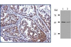CB-l at 1/1000 dilution staining EAP-Il Of human lung adenocarcinoma.