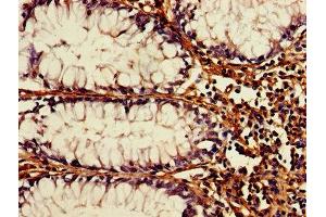 IHC image of ABIN7174567 diluted at 1:1200 and staining in paraffin-embedded human colon cancer performed on a Leica BondTM system. (ATG3 anticorps  (AA 1-314))