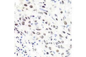 Immunohistochemistry of paraffin-embedded human lung cancer using CBX1 antibody at dilution of 1:100 (x40 lens). (CBX1 anticorps)