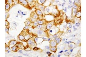 IHC-P: TNFR2 antibody testing of human breast cancer tissue (TNFRSF1B anticorps  (Middle Region))