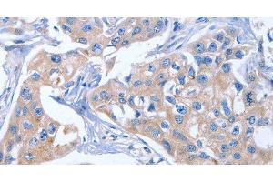 Immunohistochemistry of paraffin-embedded Human breast cancer tissue using IBSP Polyclonal Antibody at dilution of 1:50