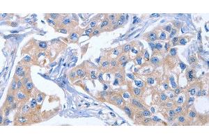 Immunohistochemistry of paraffin-embedded Human breast cancer tissue using IBSP Polyclonal Antibody at dilution of 1:50 (IBSP anticorps)