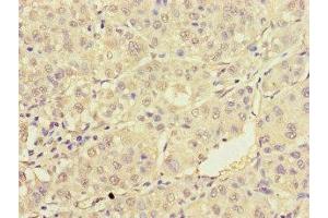 Immunohistochemistry of paraffin-embedded human liver cancer using ABIN7172232 at dilution of 1:100